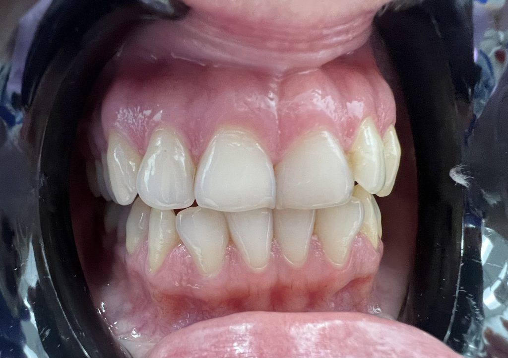 Before