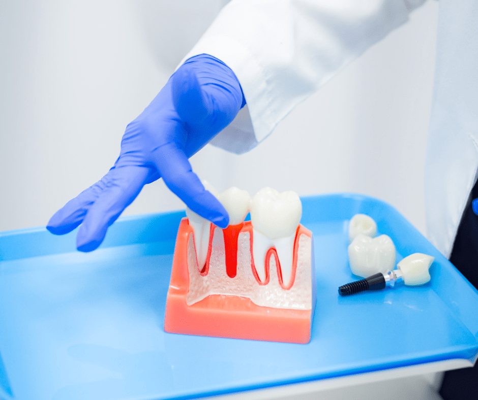 Dental Implants